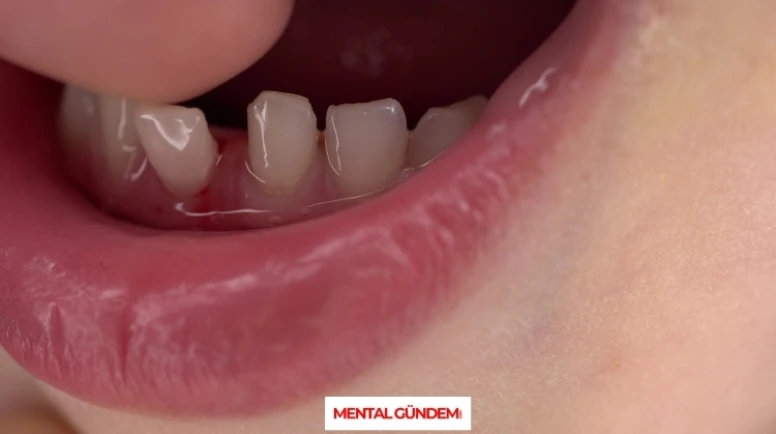 Rüyada Kendi Dişinin Sallanıp Dökülmesinin Psikolojik Yorumu